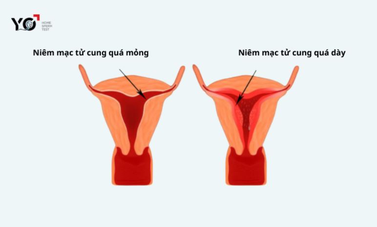 Niêm mạc tử cung quá dày hoặc mỏng khiến ảnh hưởng đến quá trình làm tổ của thai nhi